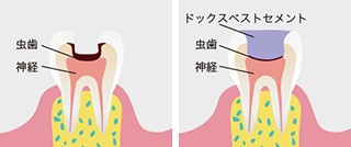 ドックスベストセメント