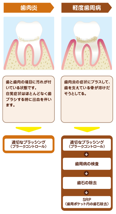 歯周病 歯槽膿漏 の治療 歯周病 歯槽膿漏 の治療 名古屋駅 名駅 の歯科 インプラント 矯正なら みやかわデンタルクリニック