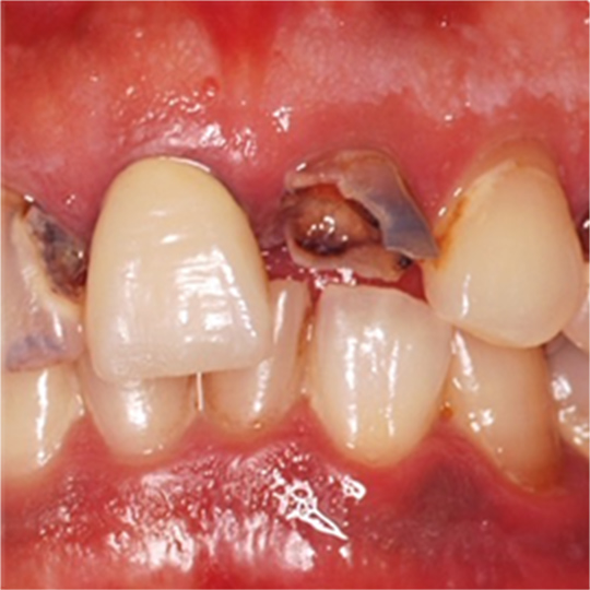 抜歯を回避する治療法