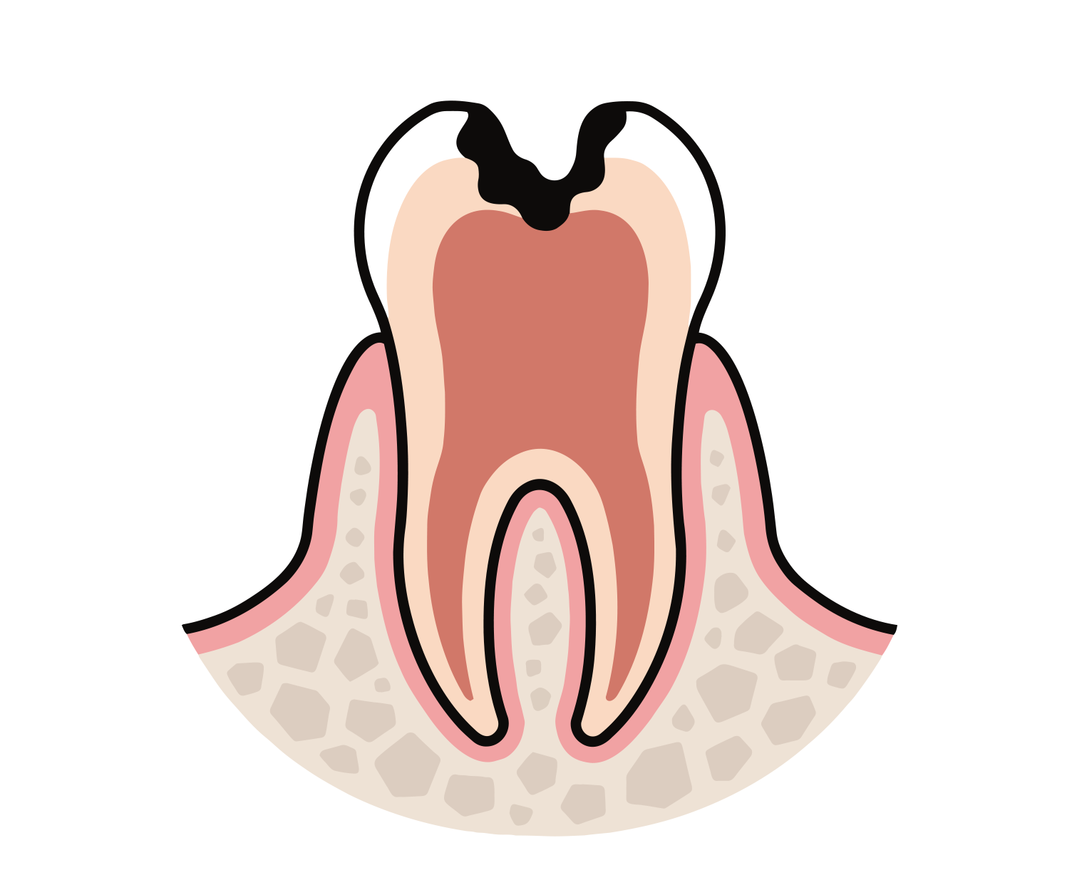 1.神経が露出する一歩手前まで虫歯を取り除く