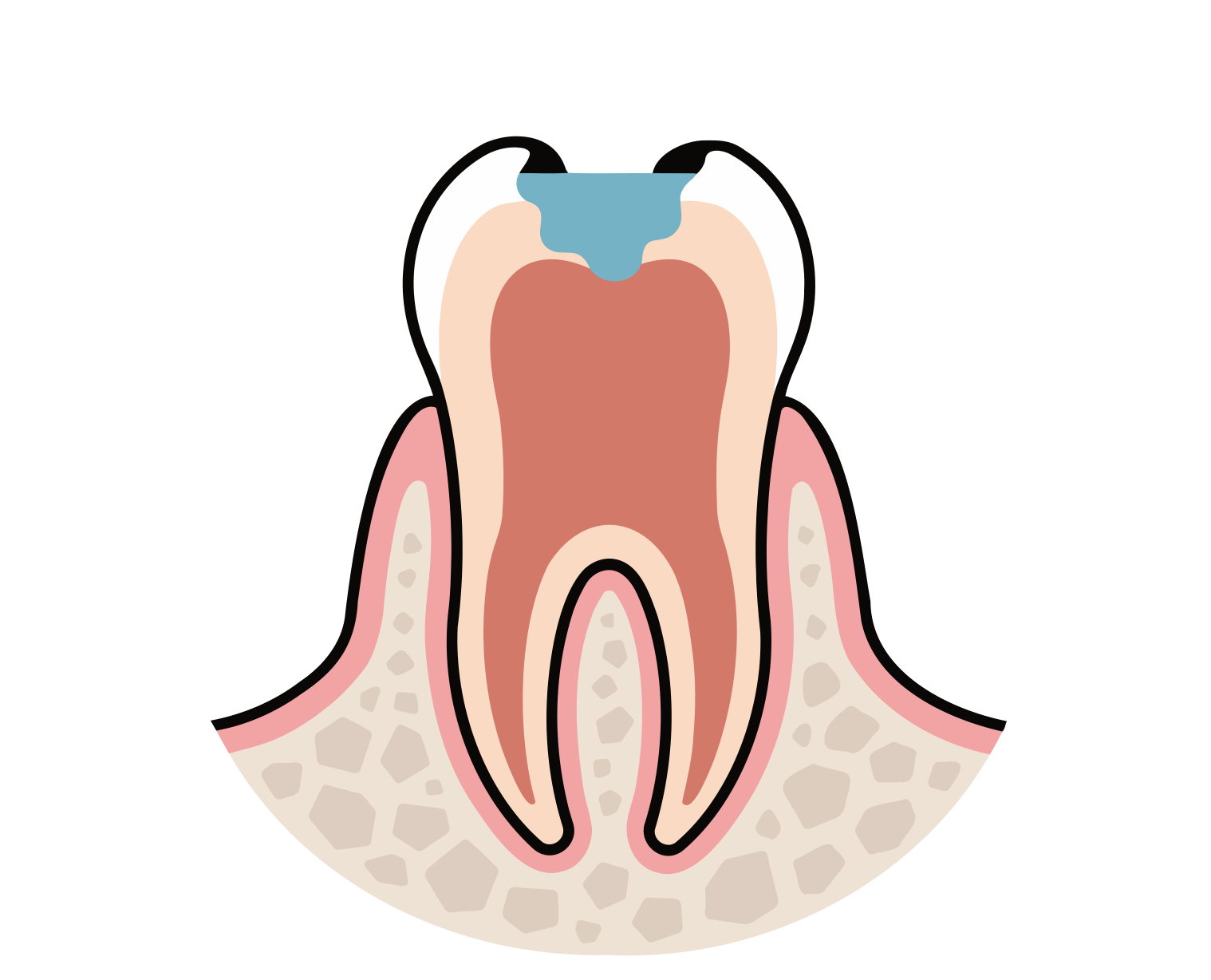 2.MTAセメントを歯の中に充填する