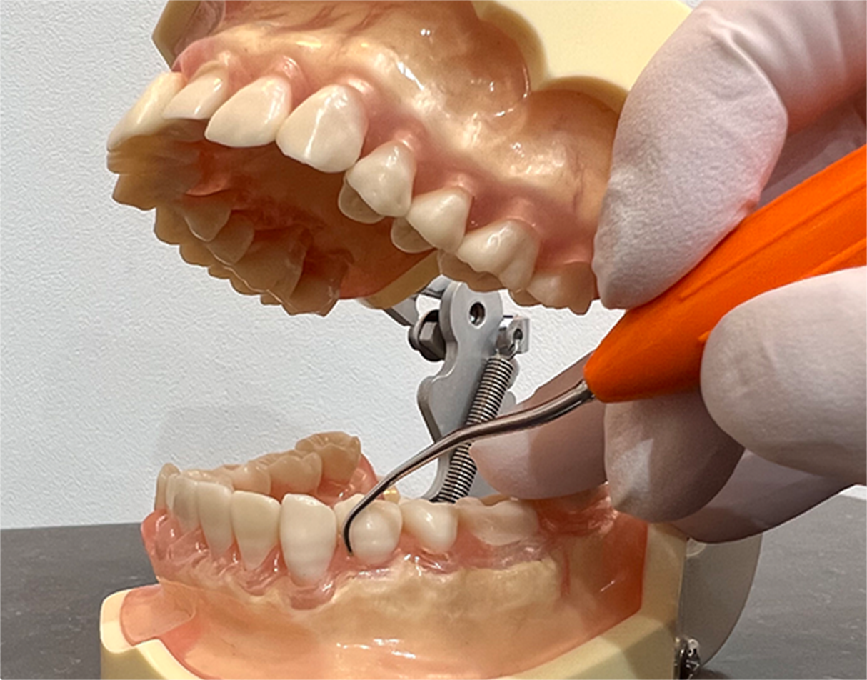歯石の除去（歯周ポケット内の歯石）