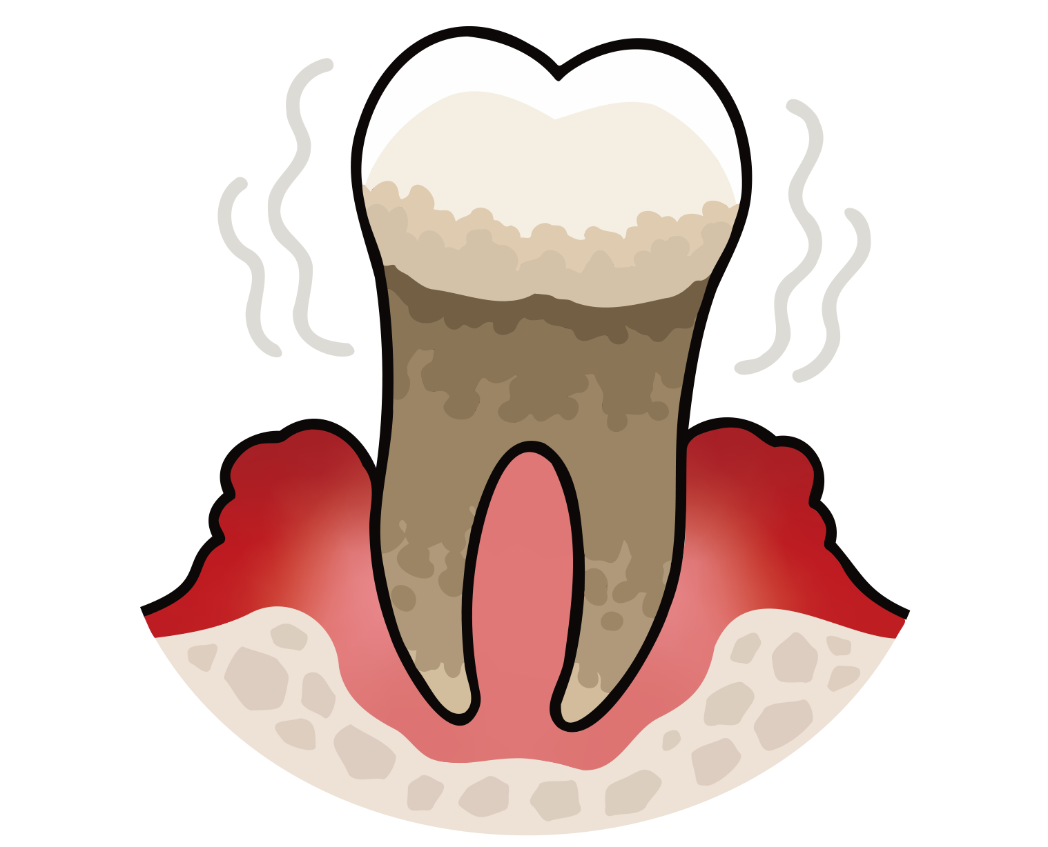 重度歯周病（歯槽膿漏）