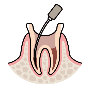 抜髄治療の流れ3