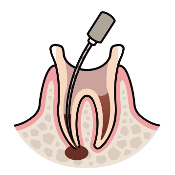 感染根管治療の流れ3