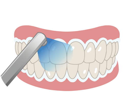 歯肉の保護・しみどめ塗布 薬剤の塗布・光照射