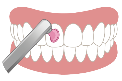 保護剤と薬剤の除去 歯面の清掃