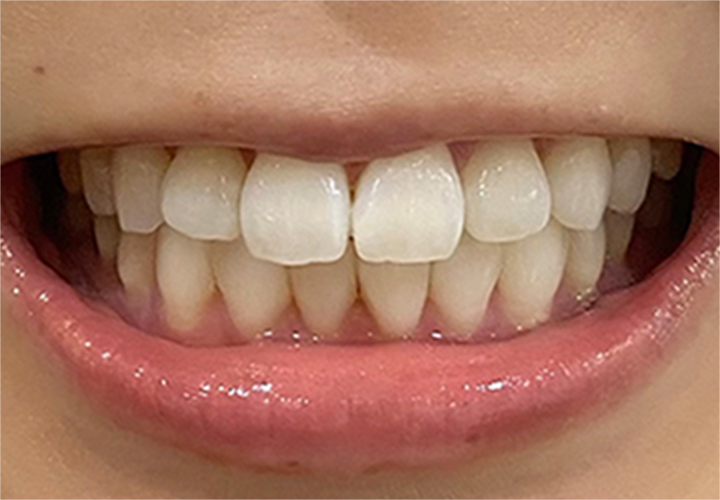 歯に優しく効果が高い「特許取得の炭酸水素塩配合」